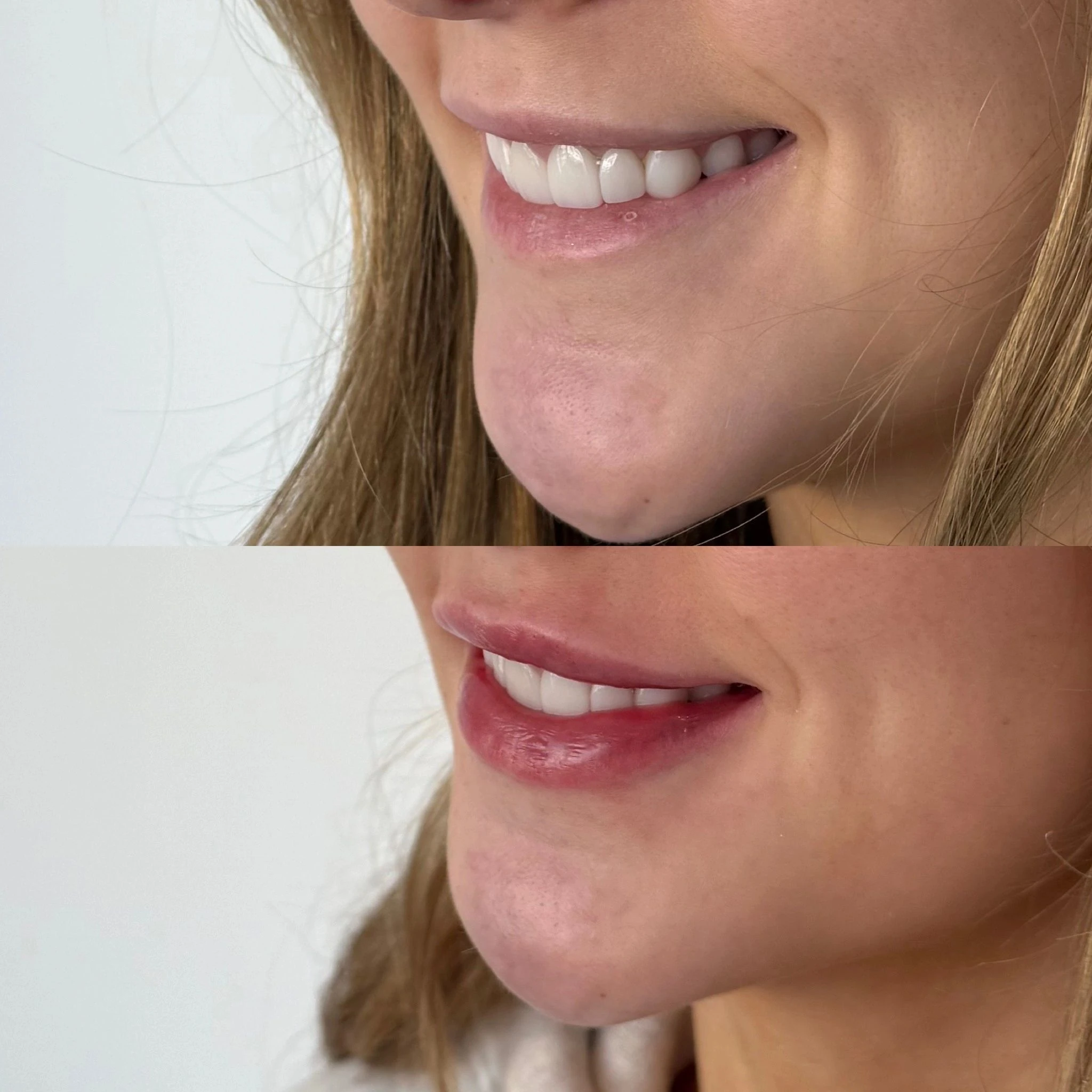 Full lip filler before and after, from Amrie’s patient gallery