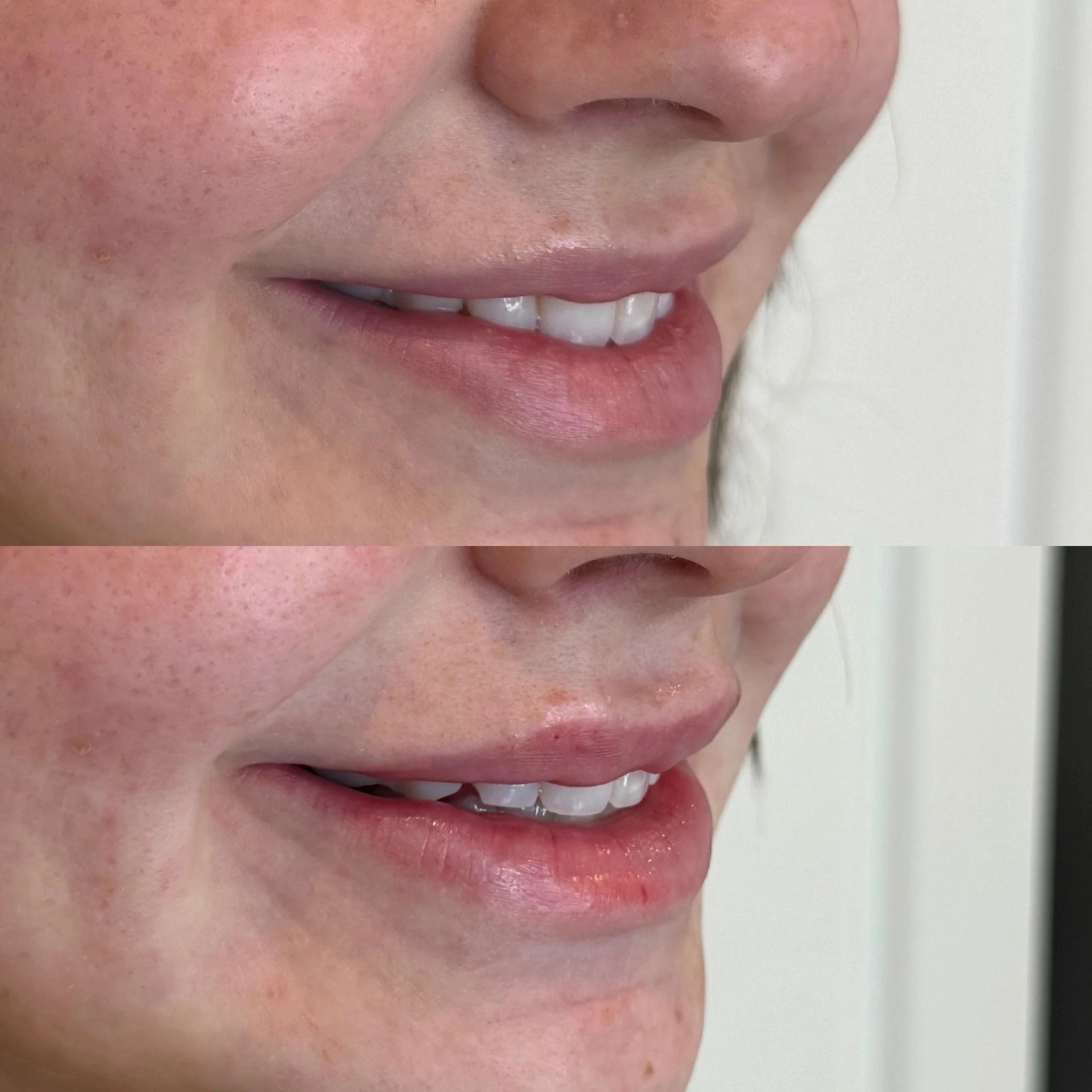Lip filler before and after, from Amrie’s patient gallery