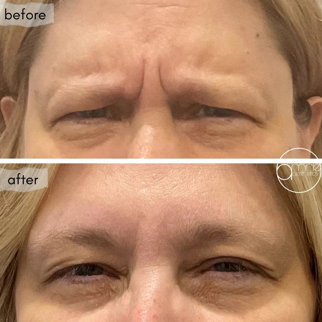 Botox · Frown lines before and after, from Amrie’s patient gallery
