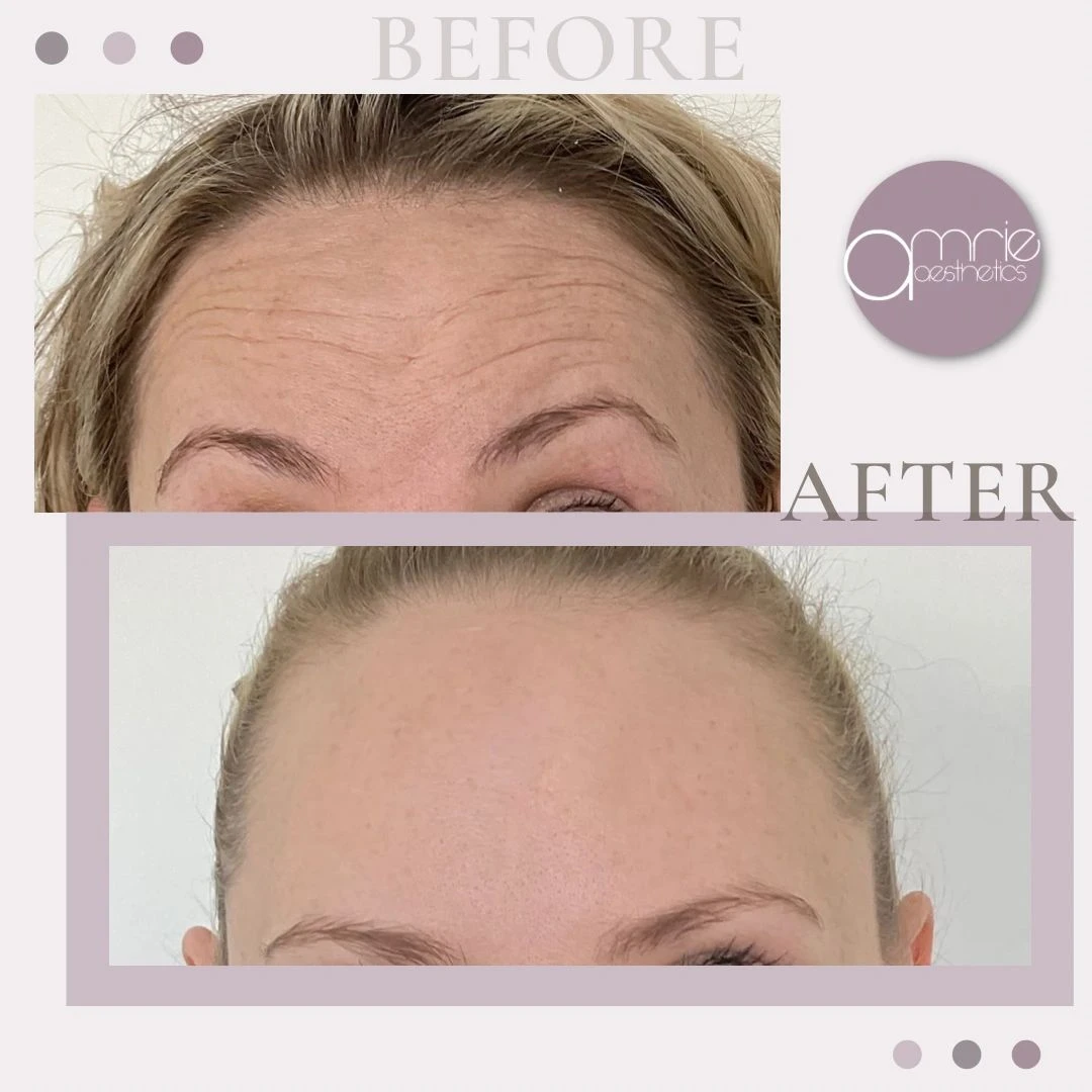 Botox · Forehead lines before and after, from Amrie’s patient gallery