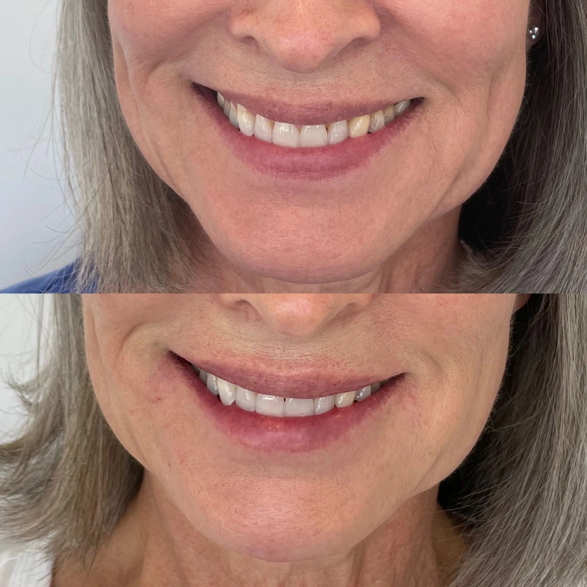 Lip filler before and after, from Amrie’s patient gallery