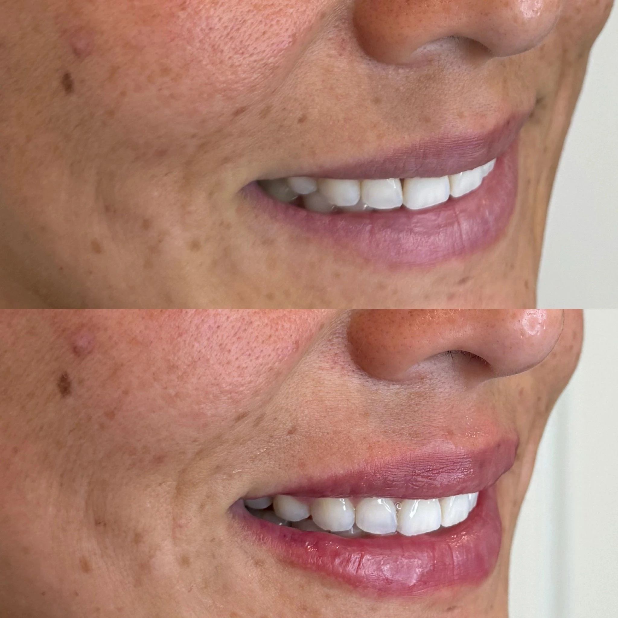 Mini lip filler before and after, from Amrie’s patient gallery