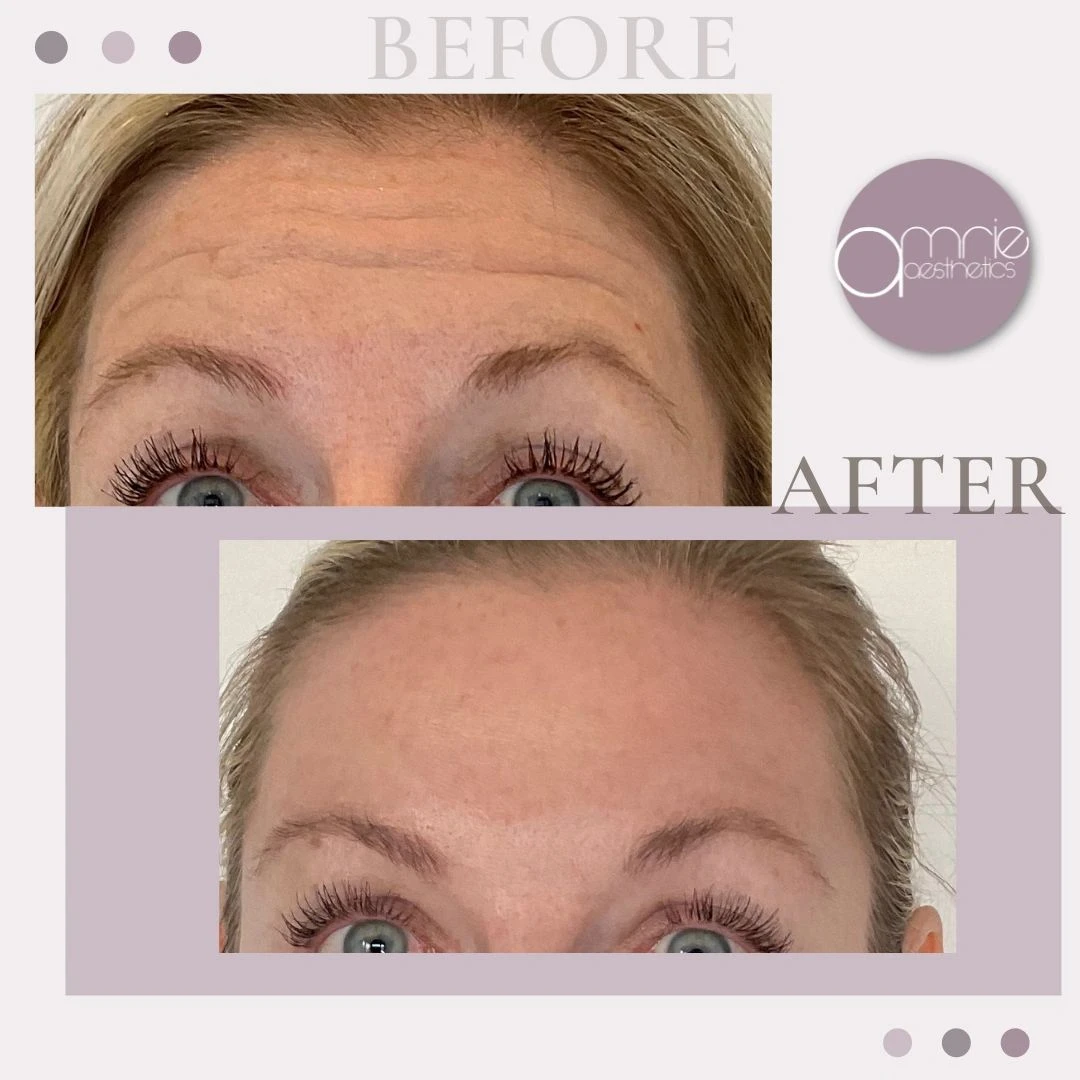 Botox · Forehead lines before and after, from Amrie’s patient gallery