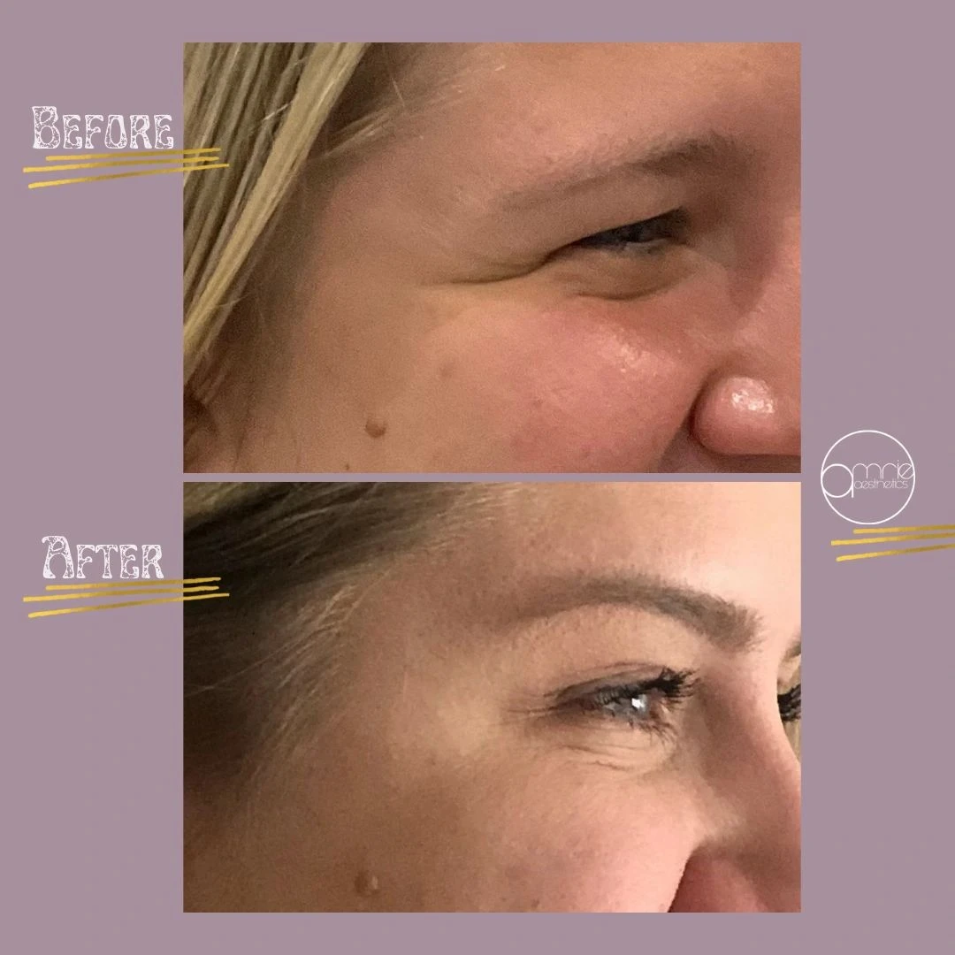 Botox · Crow’s feet before and after, from Amrie’s patient gallery