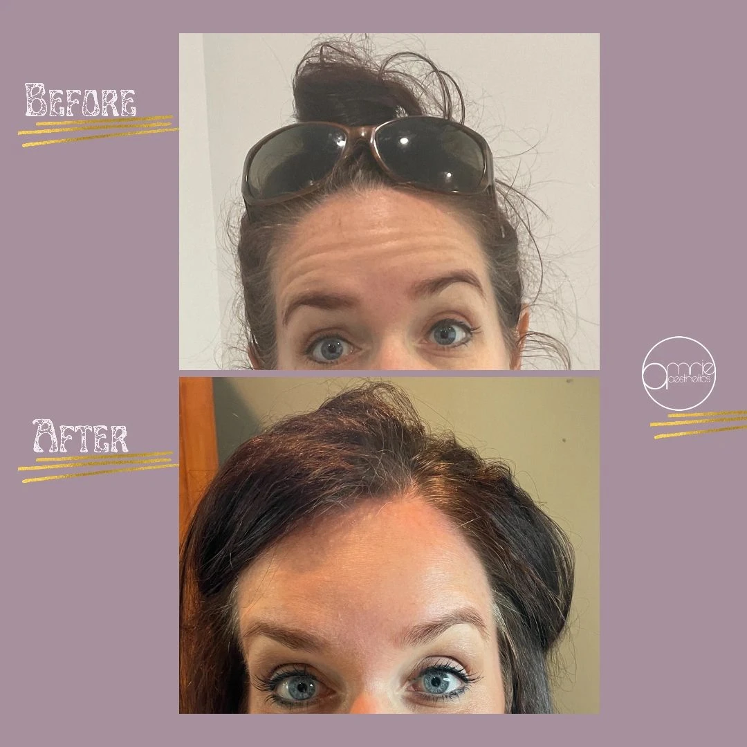 Botox · Forehead lines before and after, from Amrie’s patient gallery