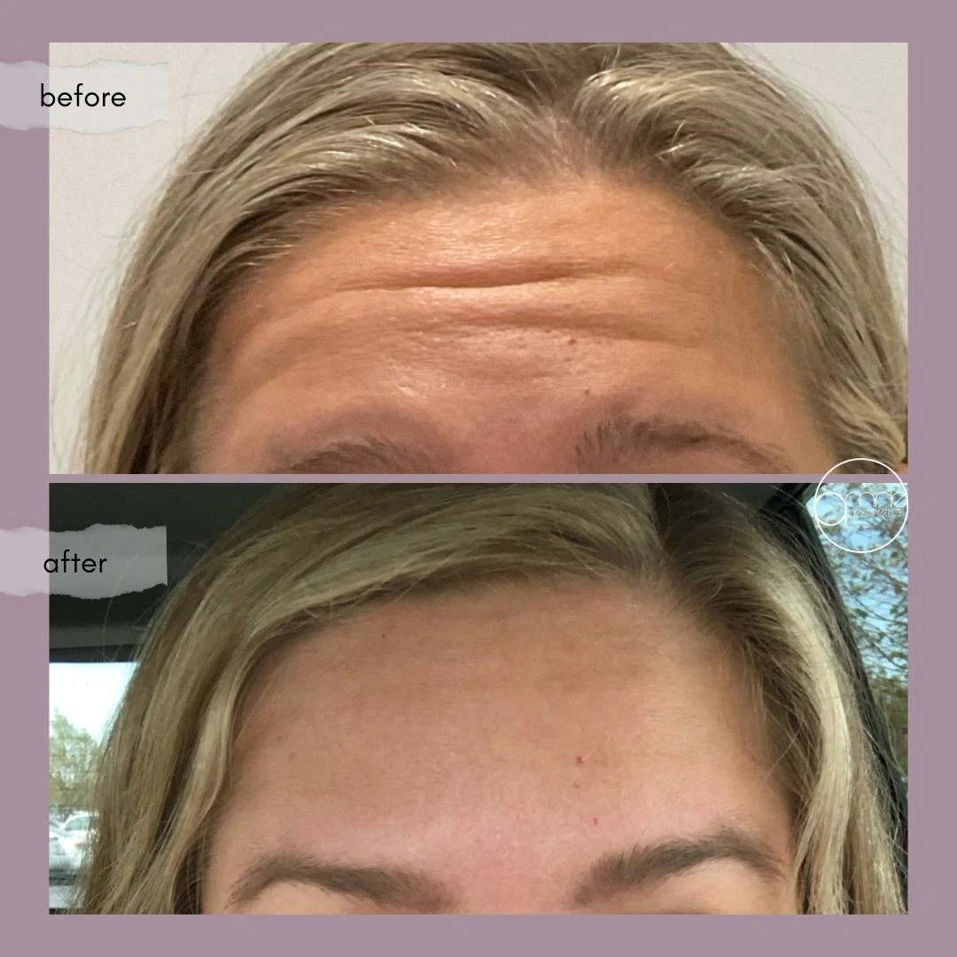 Botox · Forehead lines before and after, from Amrie’s patient gallery