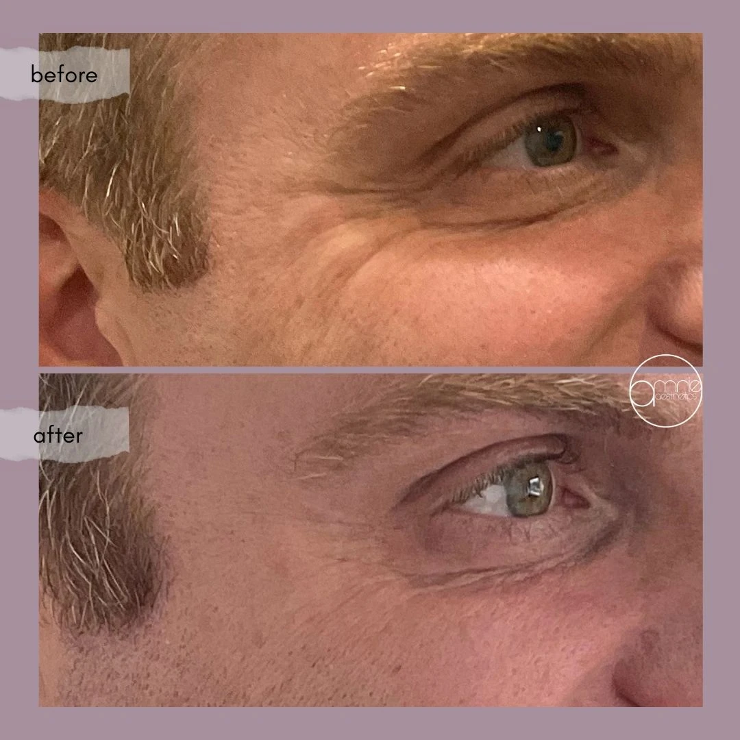 Botox · Crow’s feet before and after, from Amrie’s patient gallery